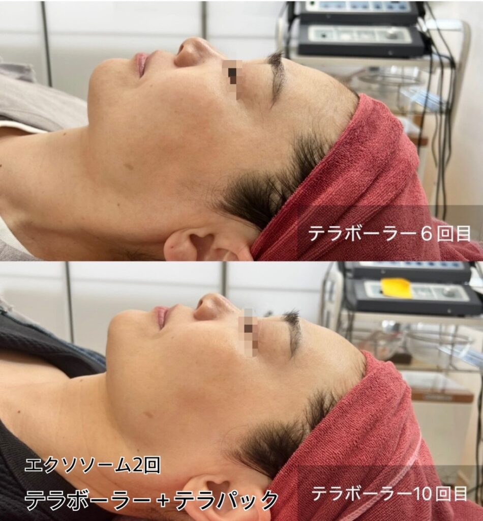 テラボーラの施術効果